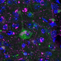 In cells that partially mimic Alzheimer's disease, the sensor protein clumps (cell in the middle, green dots), indicating a disruption in protein quality control. In addition, deposits of misfolded proteins, characteristic of Alzheimer’s disease, are seen in purple. Nuclei are stained blue.